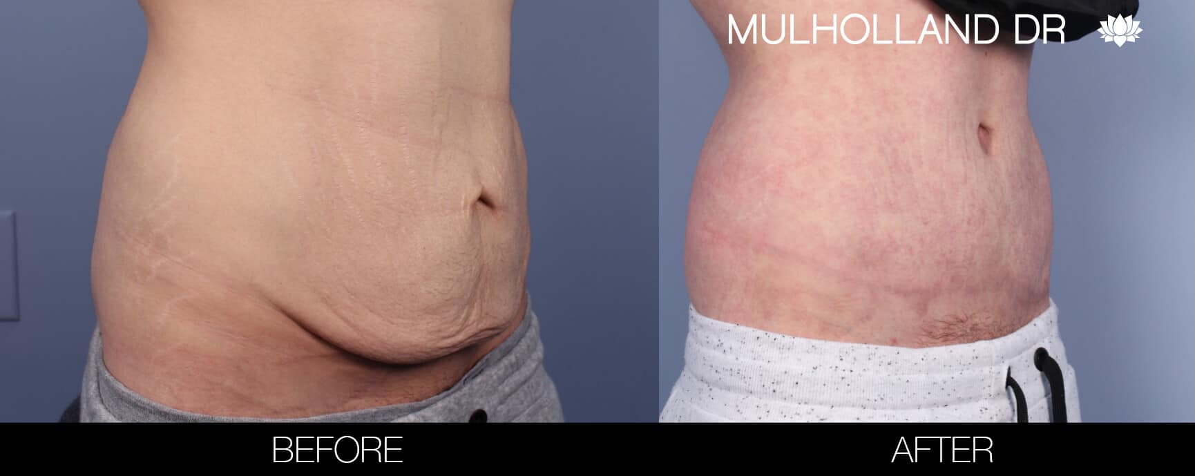 Male Tummy Tuck (Belt Lipectomy) - Before and After Gallery – Photo 4
