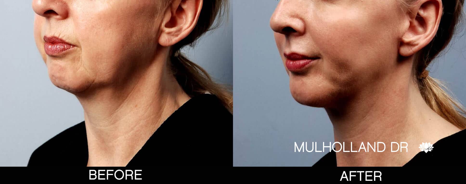 Chin Implant - Before and After Gallery – Photo 4