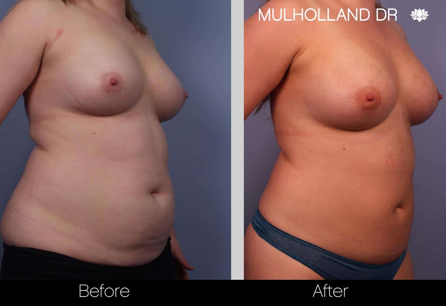 Fat Grafting Breast Augmentation - Before and After Gallery – Photo 4