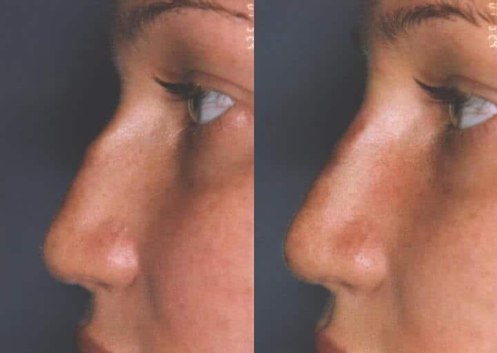 5 Minute Nose Job - Before and After Gallery – Photo 5