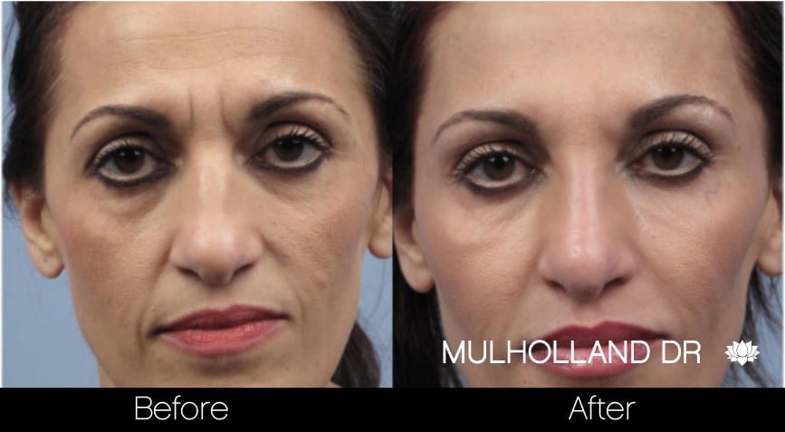 Botox Injectable - Before and After Gallery – Photo 5