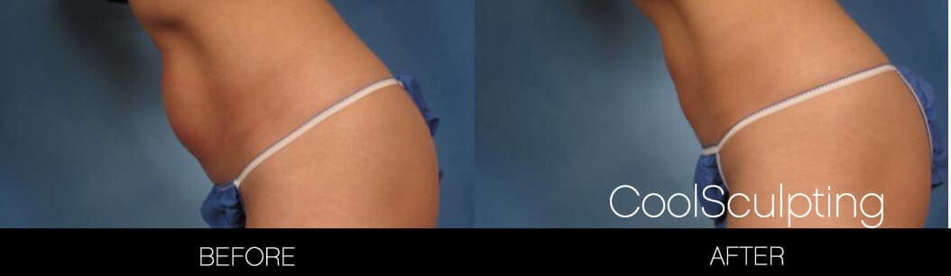 CoolSculpting - Before and After Gallery – Photo 5