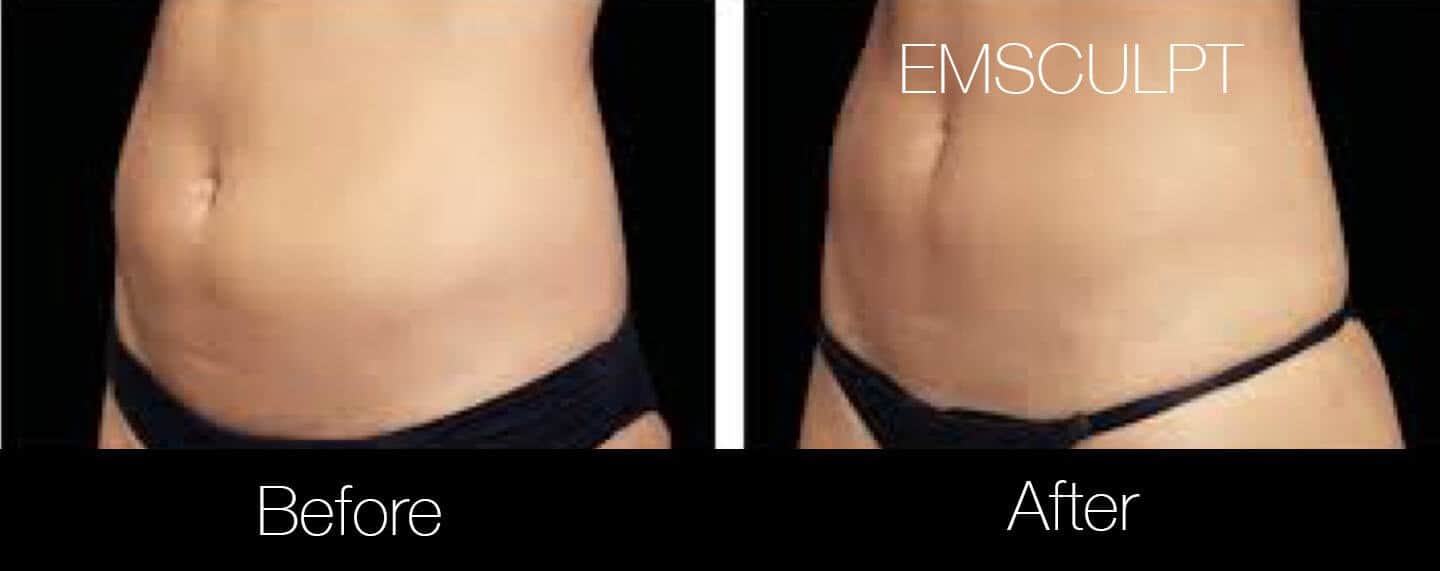 Emsculpt - Before and After Gallery – Photo 5