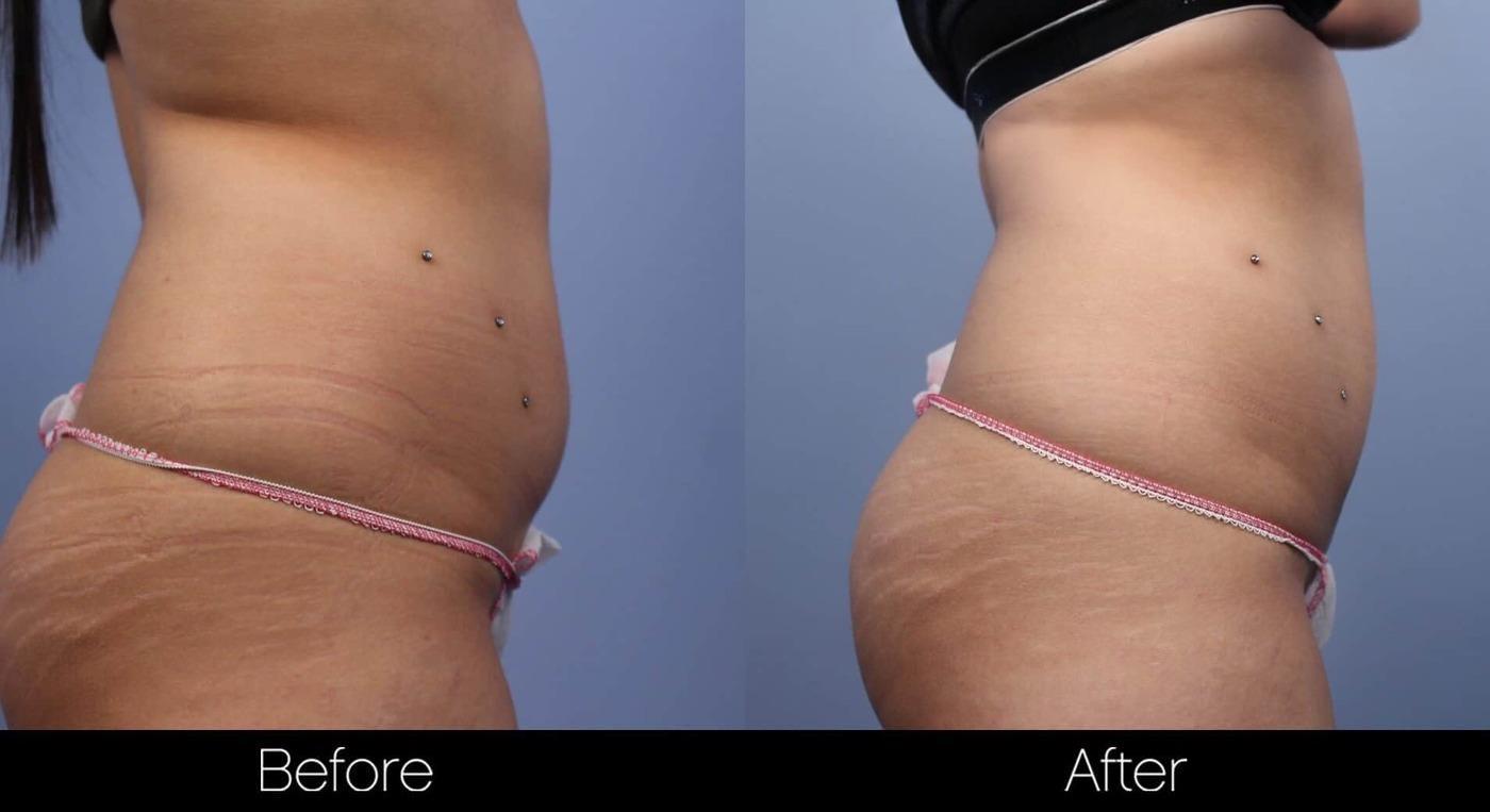 Non-Surgical Liposuction - Before and After Gallery – Photo 2