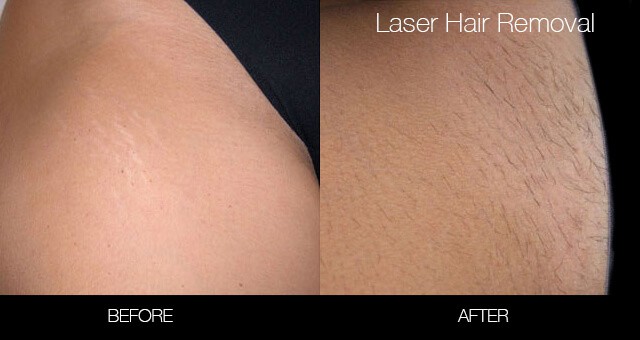 Bikini & Brazilian Laser Hair Removal - Patient Before and After Gallery – Photo 3