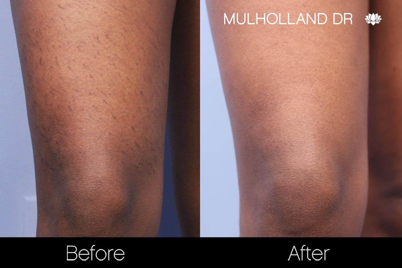 Laser Hair Removal - Patient Before and After Gallery – Photo 5