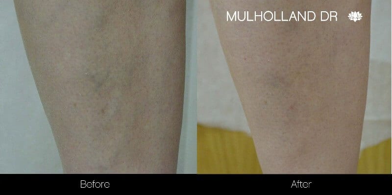 Leg Vein Reduction - Patient Before and After Gallery – Photo 5