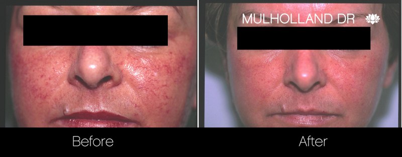 Rosacea Treatment - Patient Before and After Gallery – Photo 7