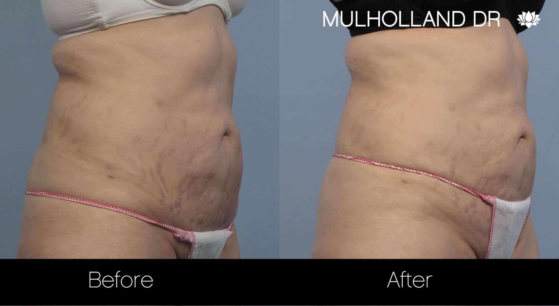 Laser Stretch Mark Removal - Patient Before and After Gallery – Photo 3