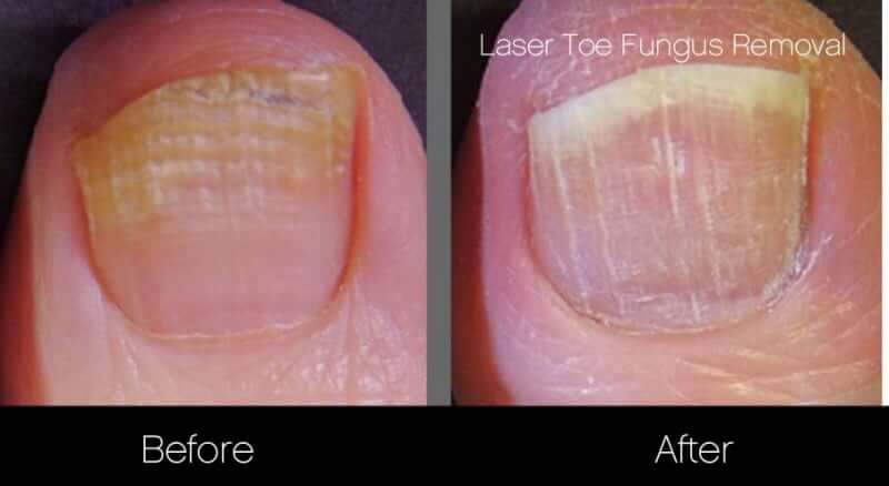 Toe Fungus Removal - Patient Before and After Gallery – Photo 5