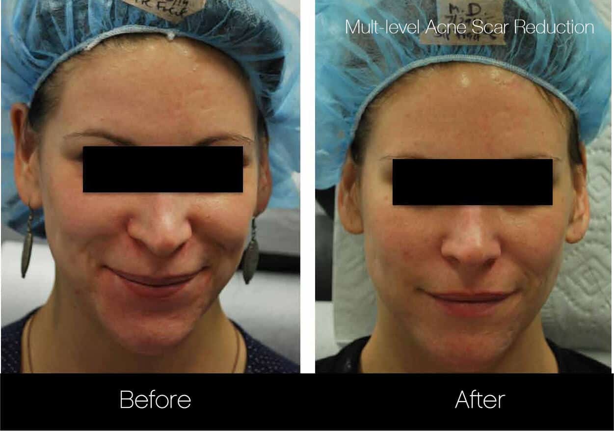 Acne Scar Treatments - Before and After Gallery – Photo 6