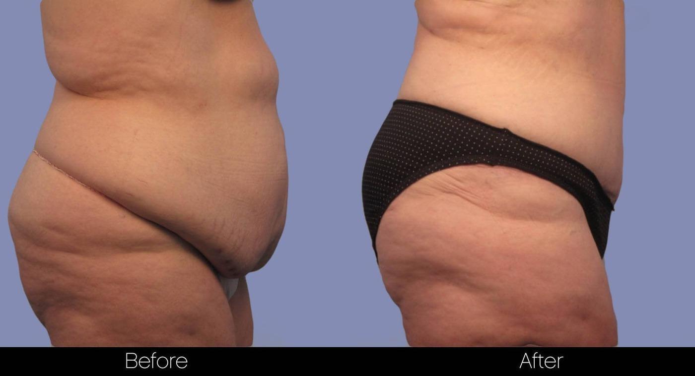Tummy Tuck - Before and After Gallery – Photo 5