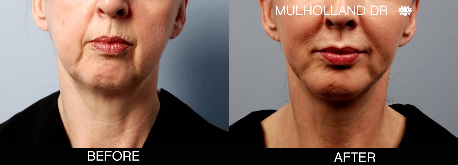 Chin Implant - Before and After Gallery – Photo 5