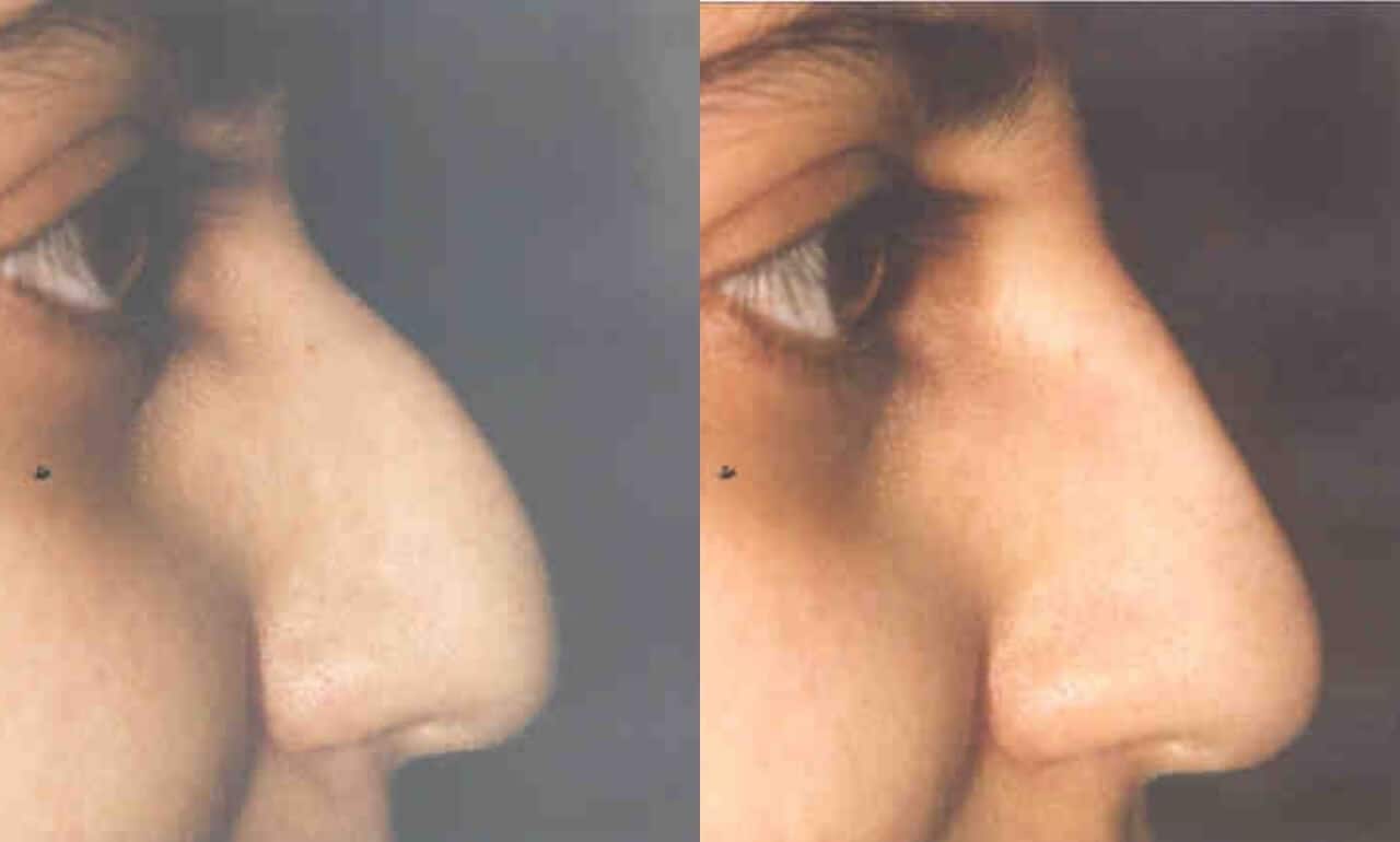 5 Minute Nose Job - Before and After Gallery – Photo 6