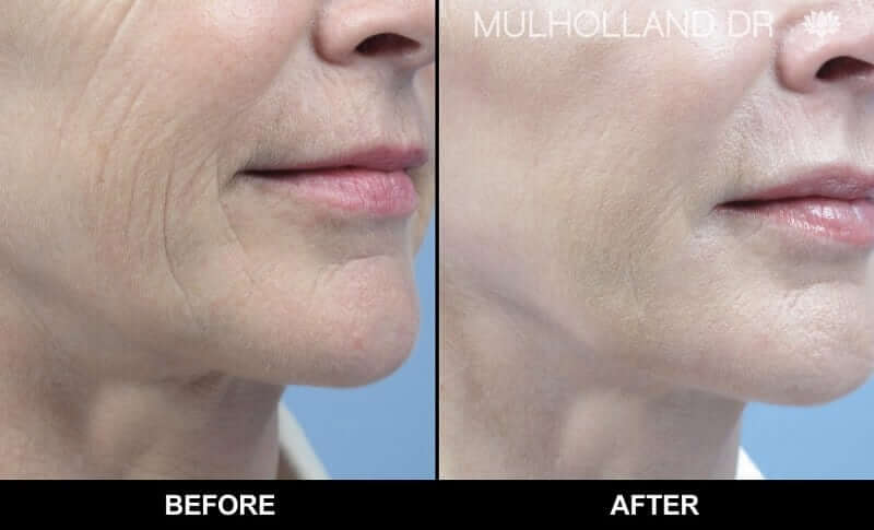 Non-Surgical Facelift - Before and After Gallery – Photo 6
