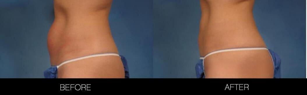 CoolSculpting - Before and After Gallery – Photo 6