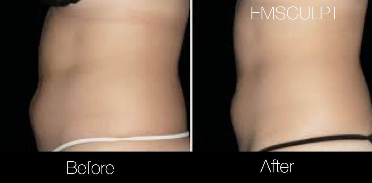 Emsculpt - Before and After Gallery – Photo 6