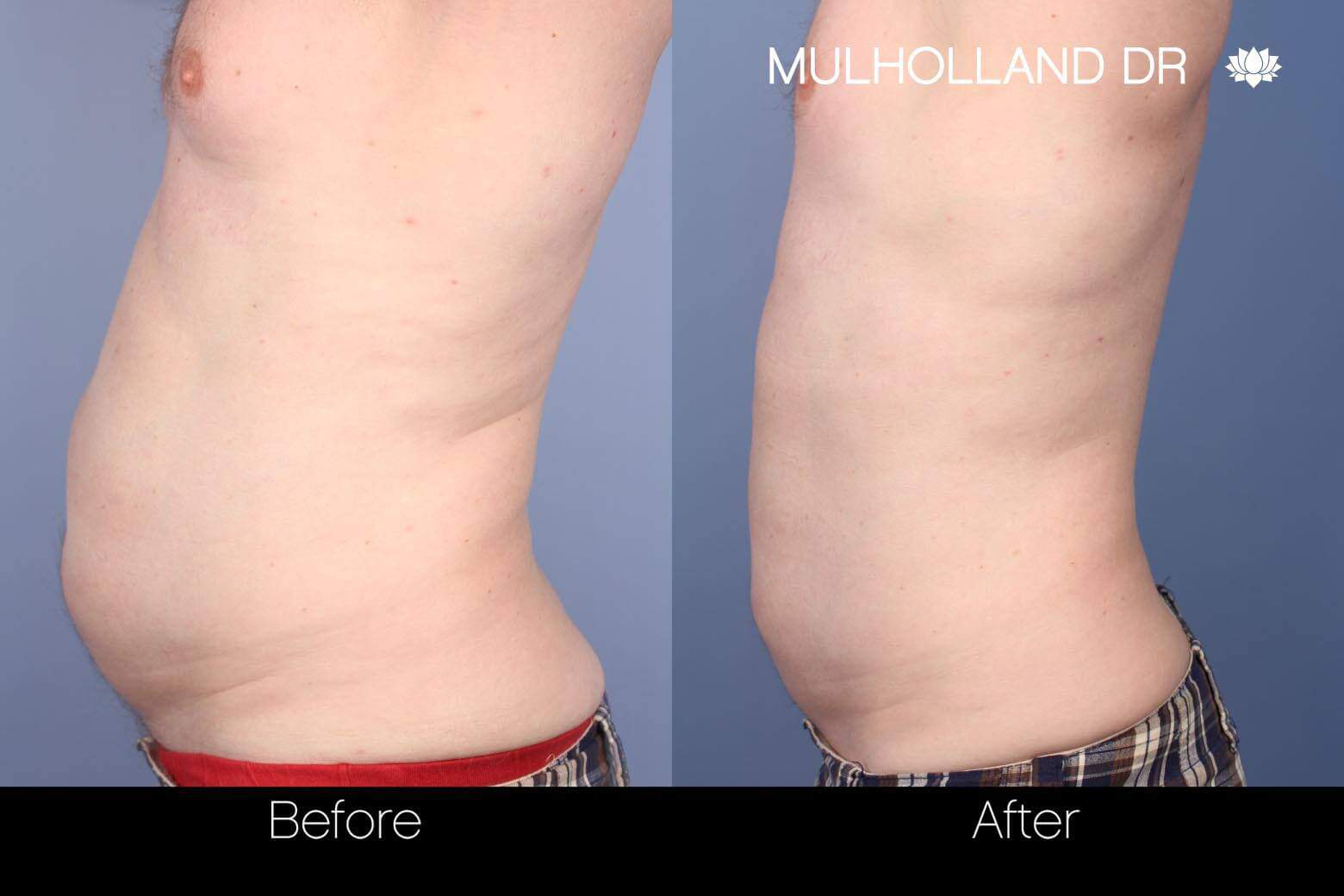 SculpSure - Before and After Gallery – Photo 6