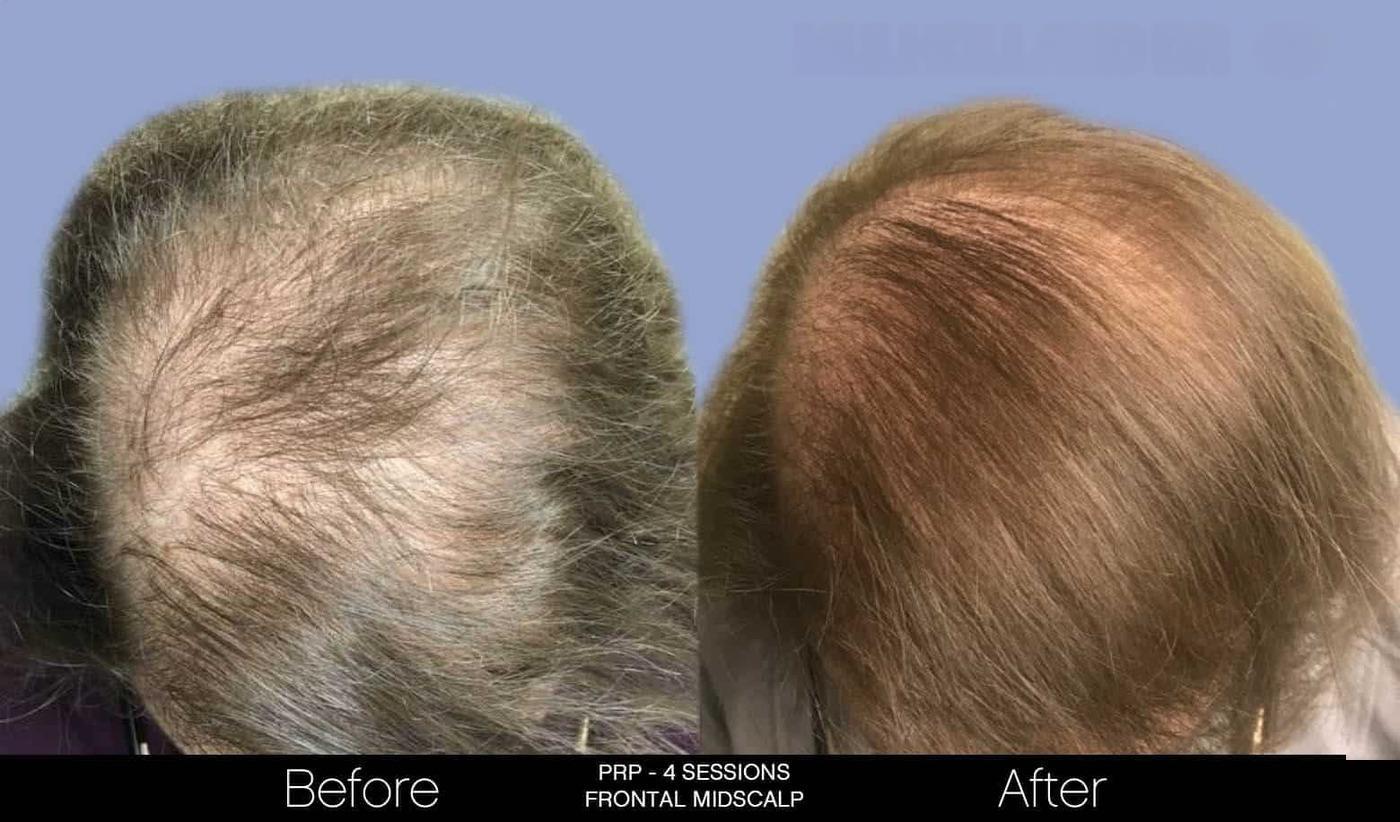 Non-Surgical Hair Restoration - Patient Before and After Gallery – Photo 6