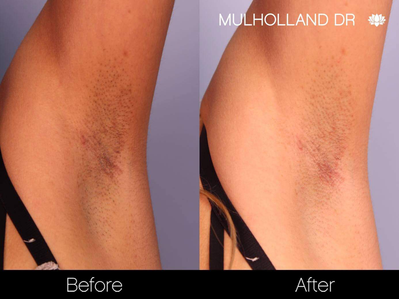 Laser Hair Removal - Patient Before and After Gallery – Photo 6