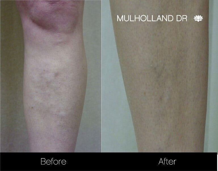 Leg Vein Reduction - Patient Before and After Gallery – Photo 6