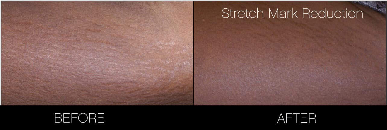 Laser Stretch Mark Removal - Patient Before and After Gallery – Photo 6