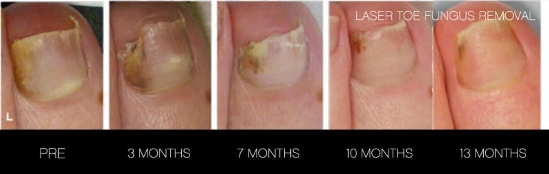 Toe Fungus Removal - Patient Before and After Gallery – Photo 6