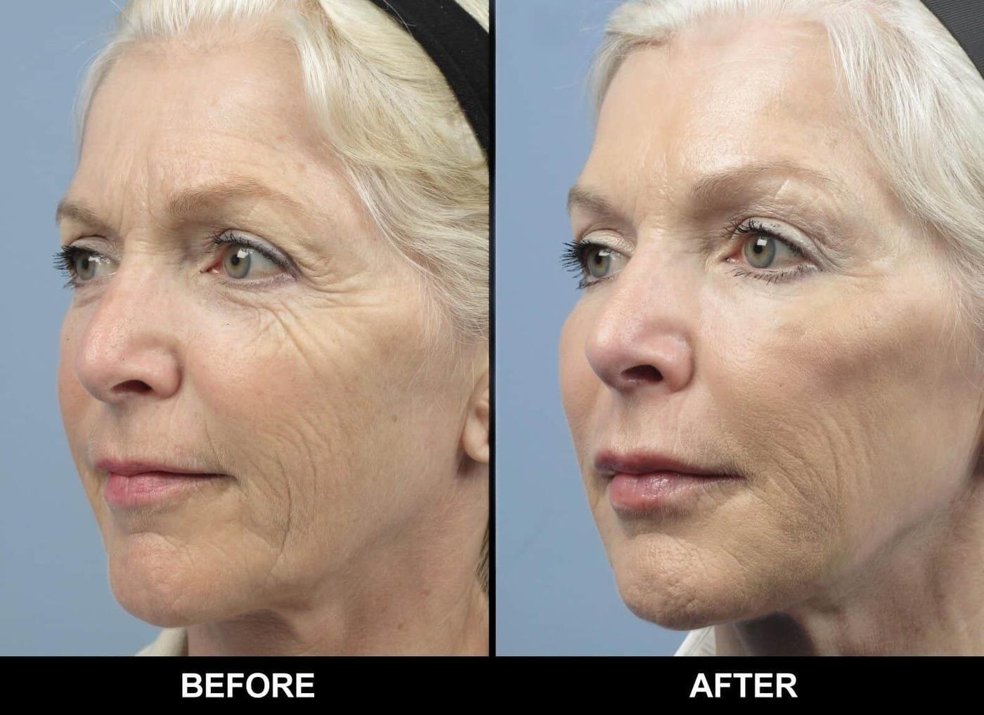 Microdermabrasion - Before and After Gallery – Photo 9