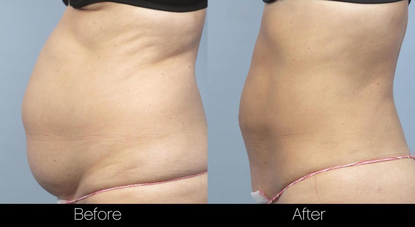 Smart Lipo - Before and After Gallery – Photo 6