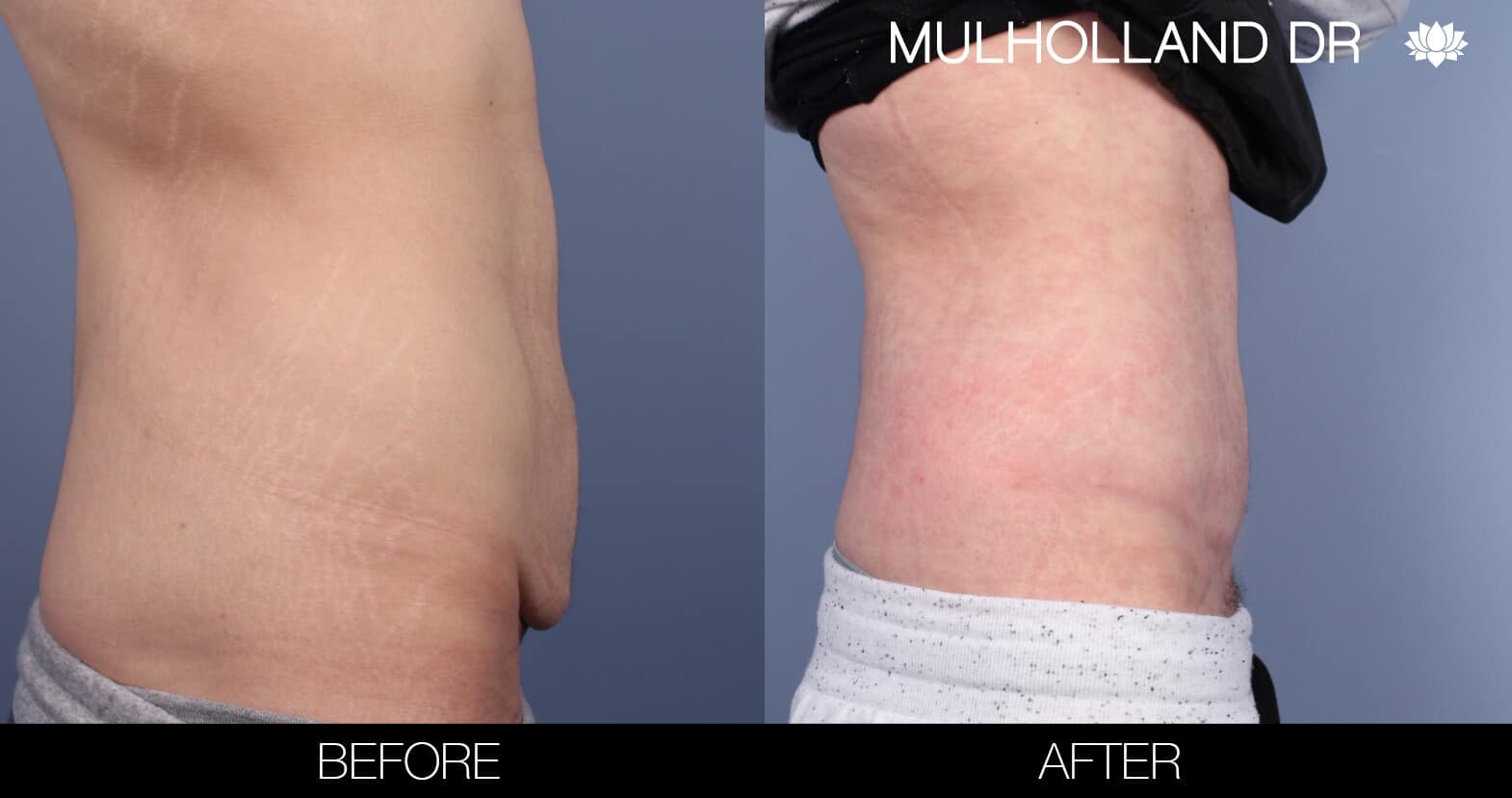 Male Tummy Tuck (Belt Lipectomy) - Before and After Gallery – Photo 6
