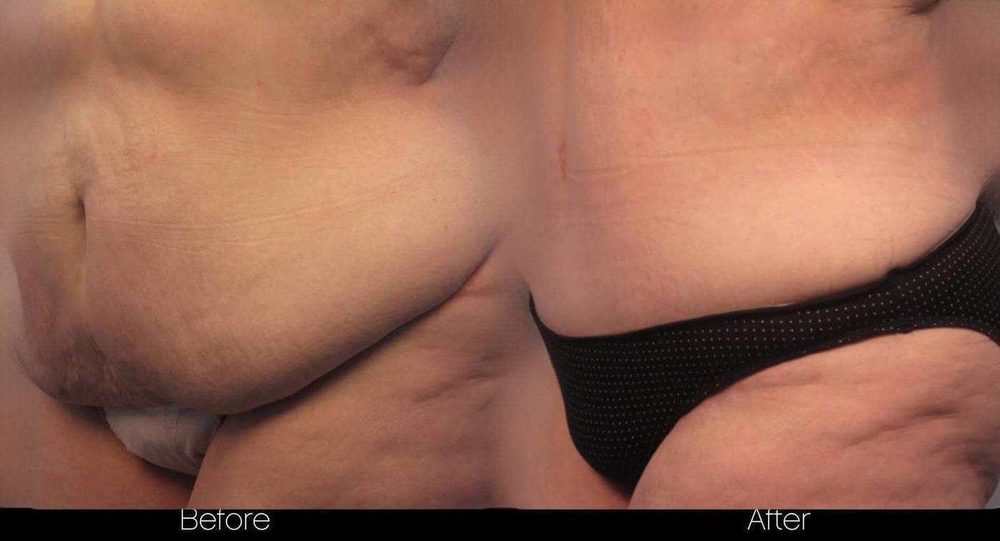 Tummy Tuck - Before and After Gallery – Photo 6