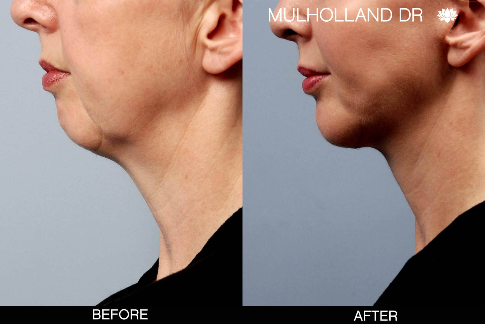 Chin Implant - Before and After Gallery – Photo 6