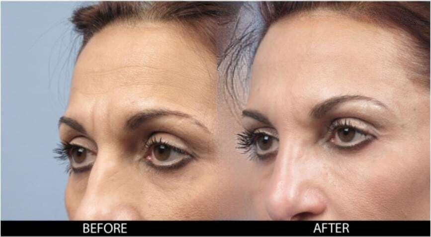 Botox Injectable - Before and After Gallery – Photo 7