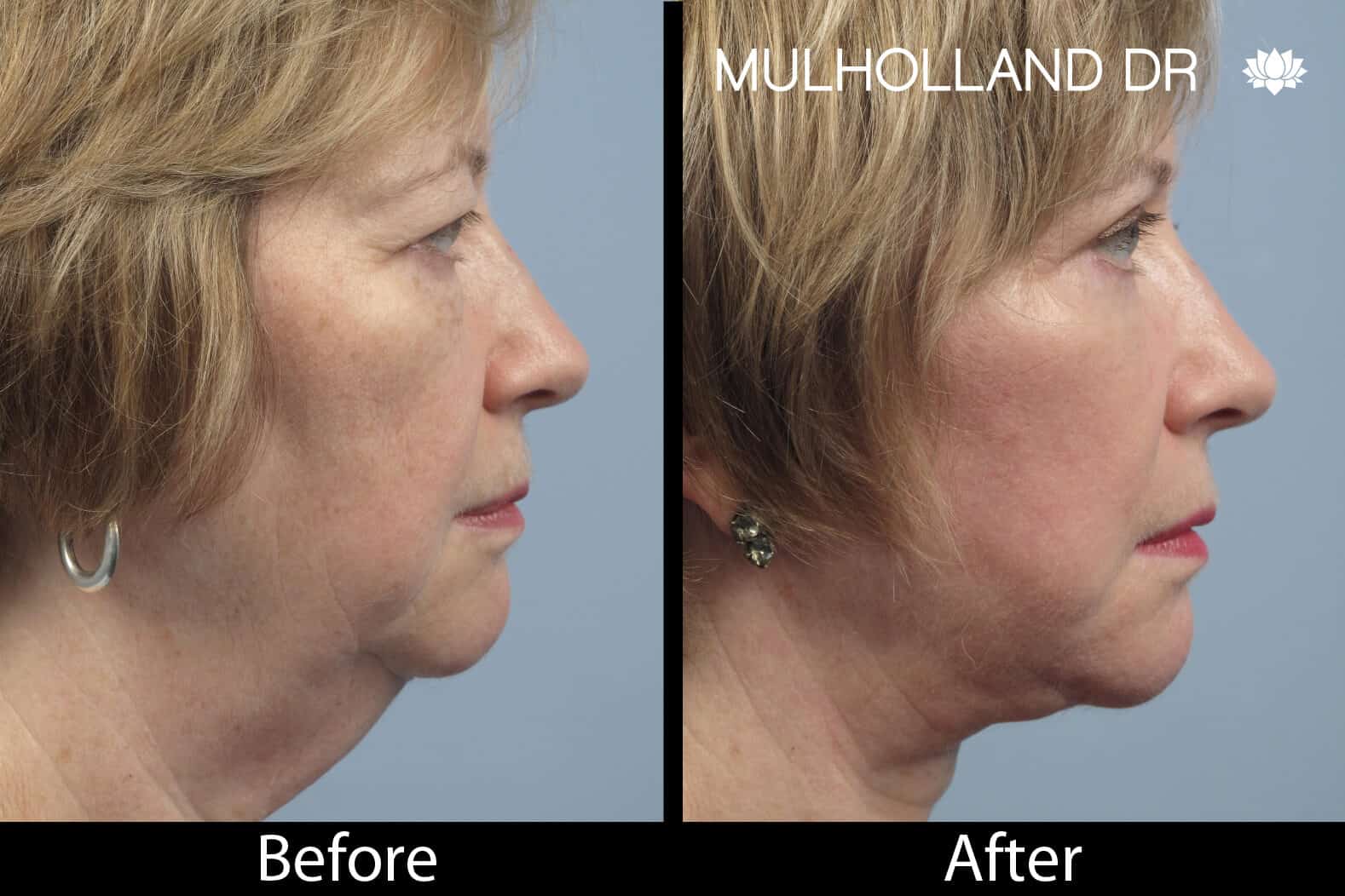 Non-Surgical Facelift - Before and After Gallery – Photo 7