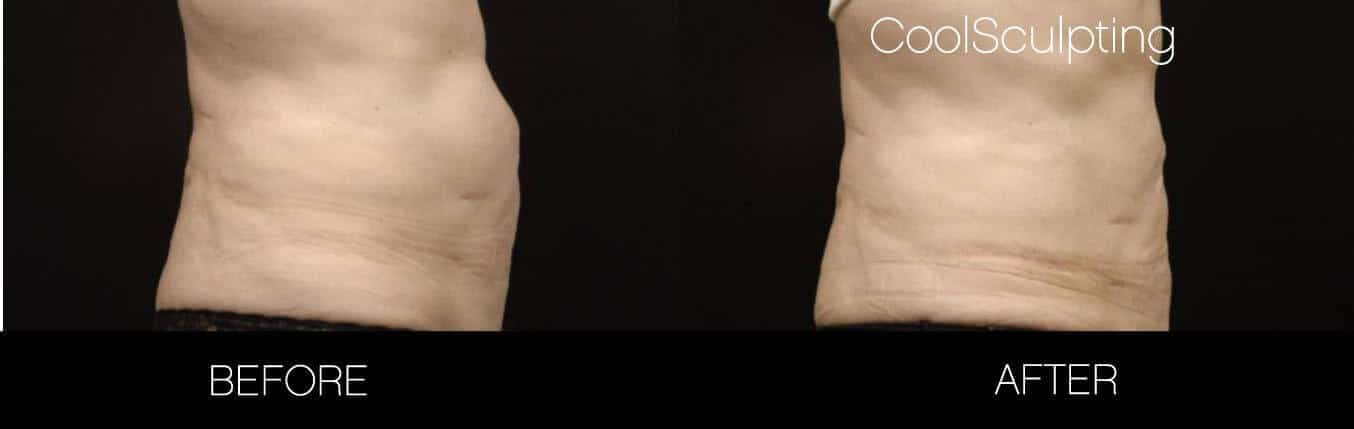 CoolSculpting - Before and After Gallery – Photo 7