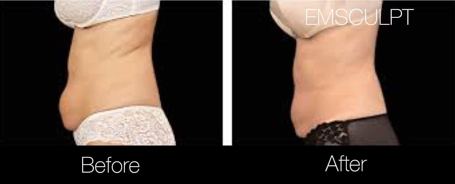 Emsculpt - Before and After Gallery – Photo 7