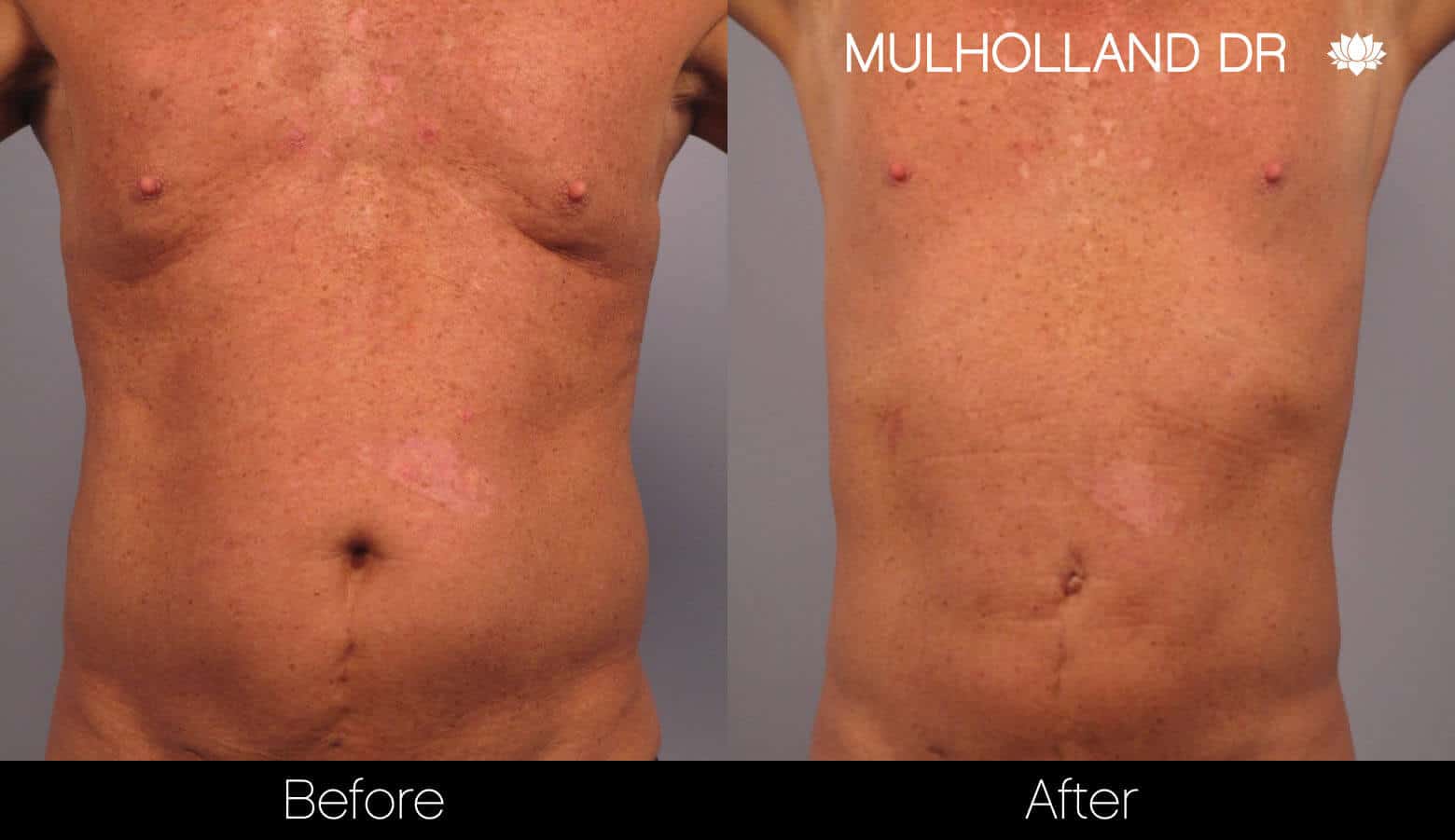 Non-Surgical Liposuction - Before and After Gallery – Photo 7