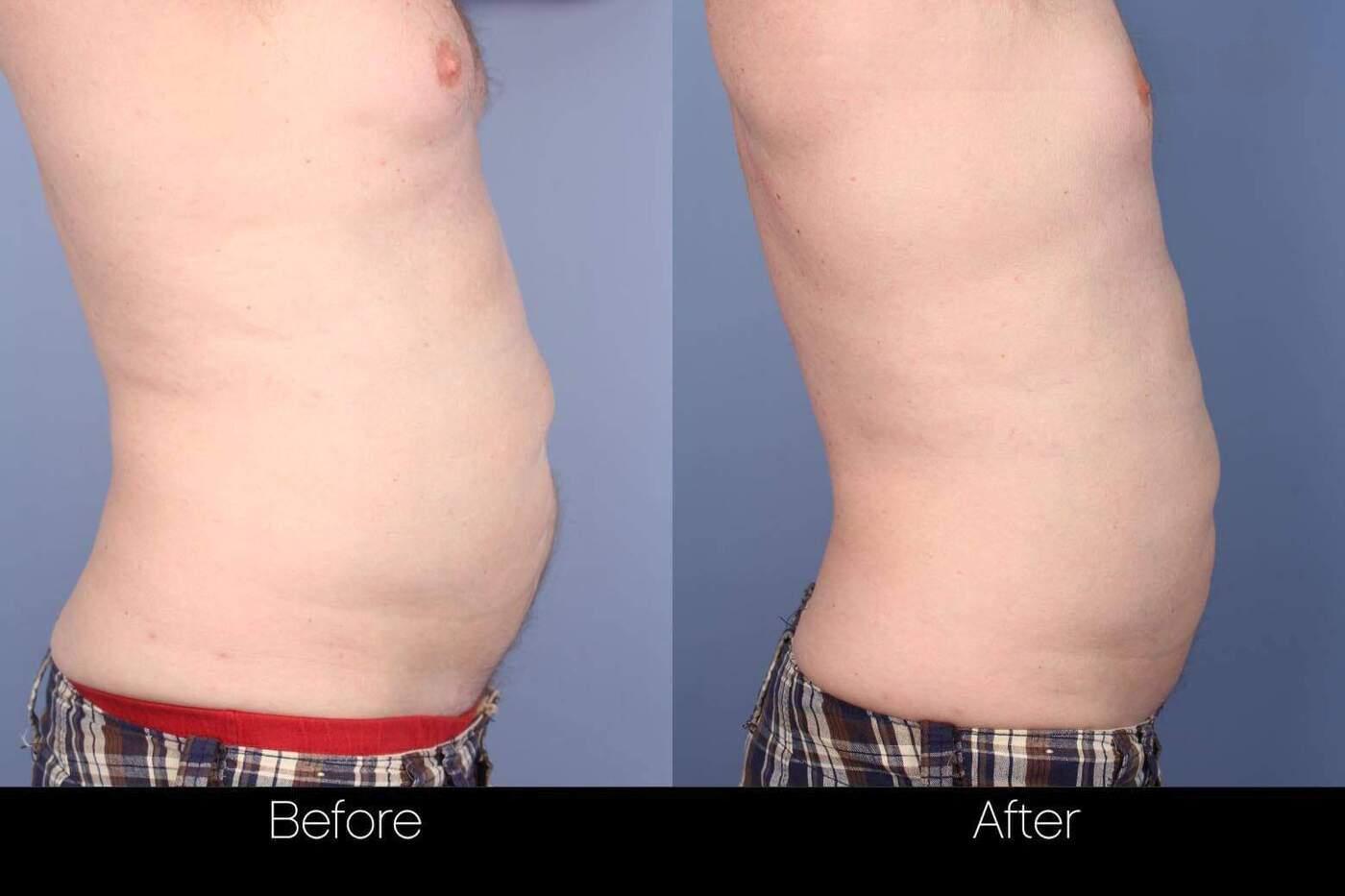 SculpSure - Before and After Gallery – Photo 7