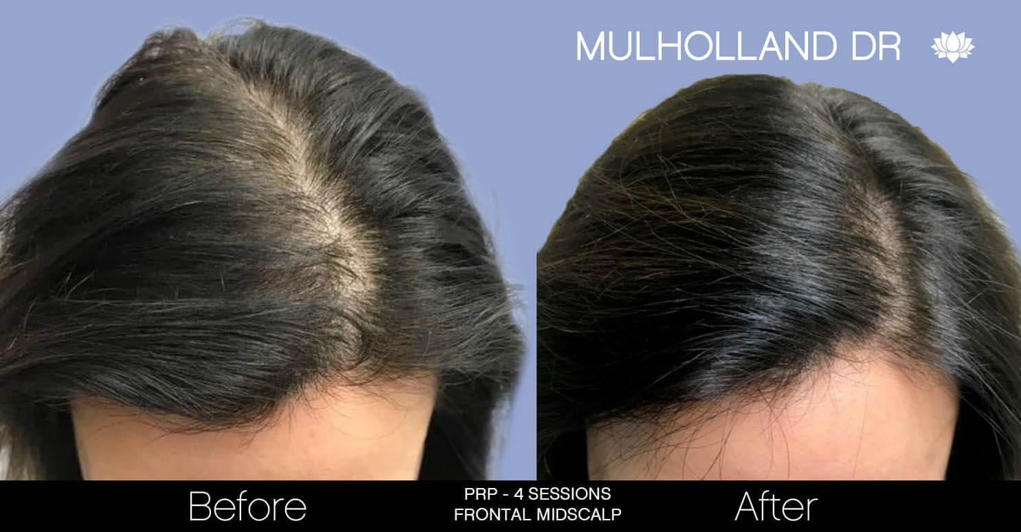 Non-Surgical Hair Restoration - Patient Before and After Gallery – Photo 7