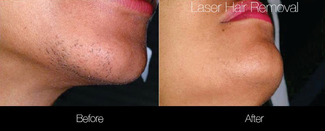 Laser Hair Removal - Patient Before and After Gallery – Photo 7