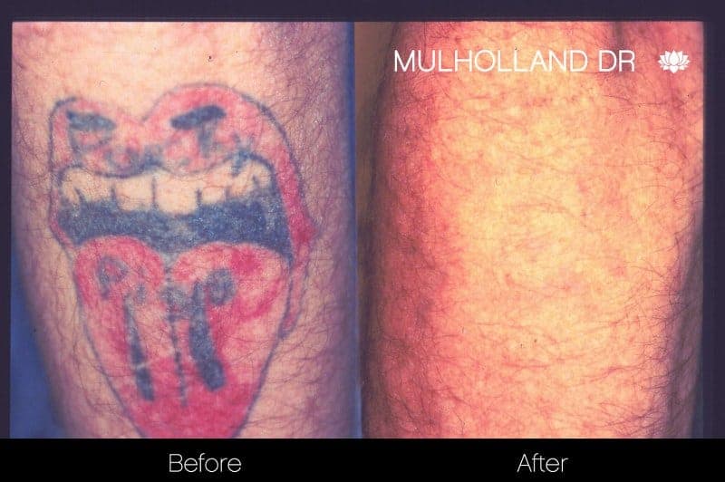Laser Tattoo Removal - Before and After Gallery – Photo 7