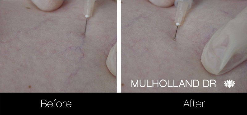 Leg Vein Reduction - Patient Before and After Gallery – Photo 7