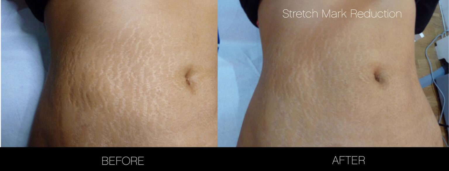 How To Get Rid Of Stretch Marks Toronto Spamedica