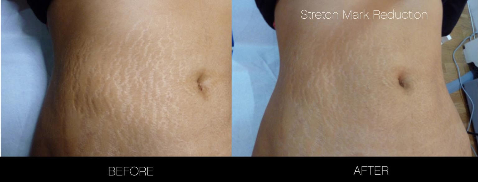 How To Get Rid Of Stretch Marks Toronto SpaMedica