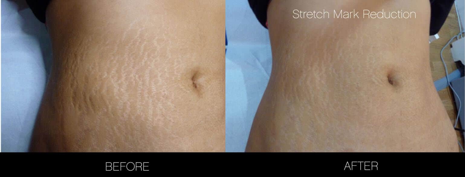 Laser Stretch Mark Removal in Toronto | SpaMedica