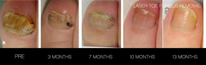 Toe Fungus Removal - Patient Before and After Gallery – Photo 7