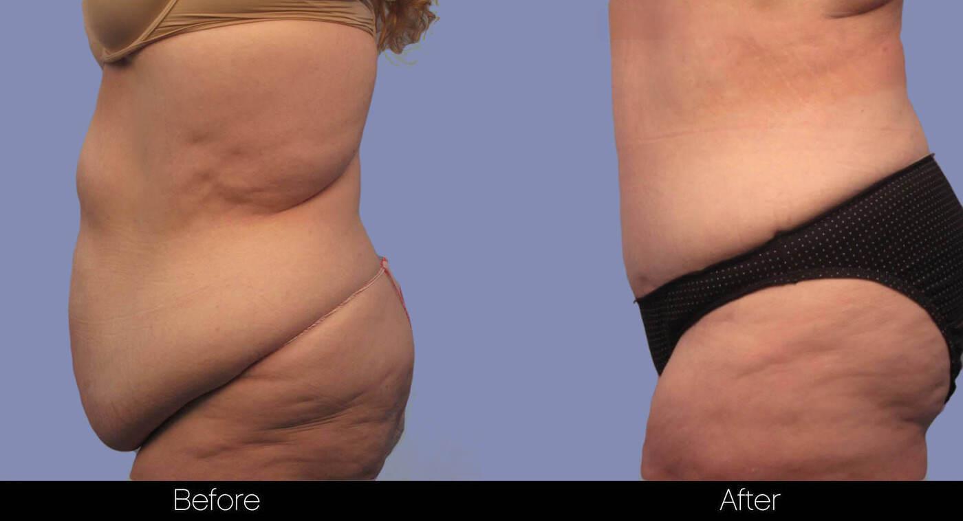 Tummy Tuck - Before and After Gallery – Photo 7