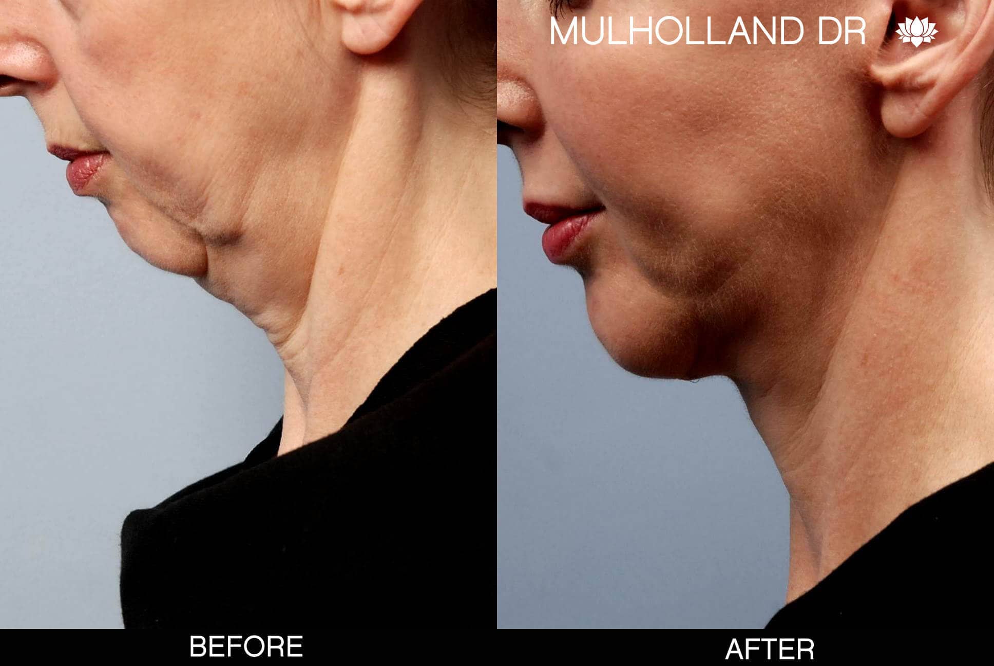 Chin Implant - Before and After Gallery – Photo 7