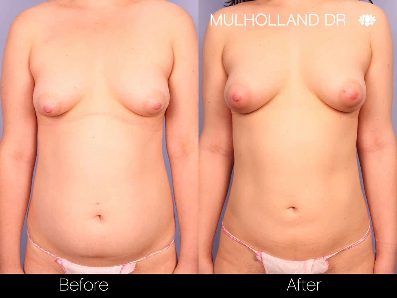 Fat Grafting Breast Augmentation - Before and After Gallery – Photo 7