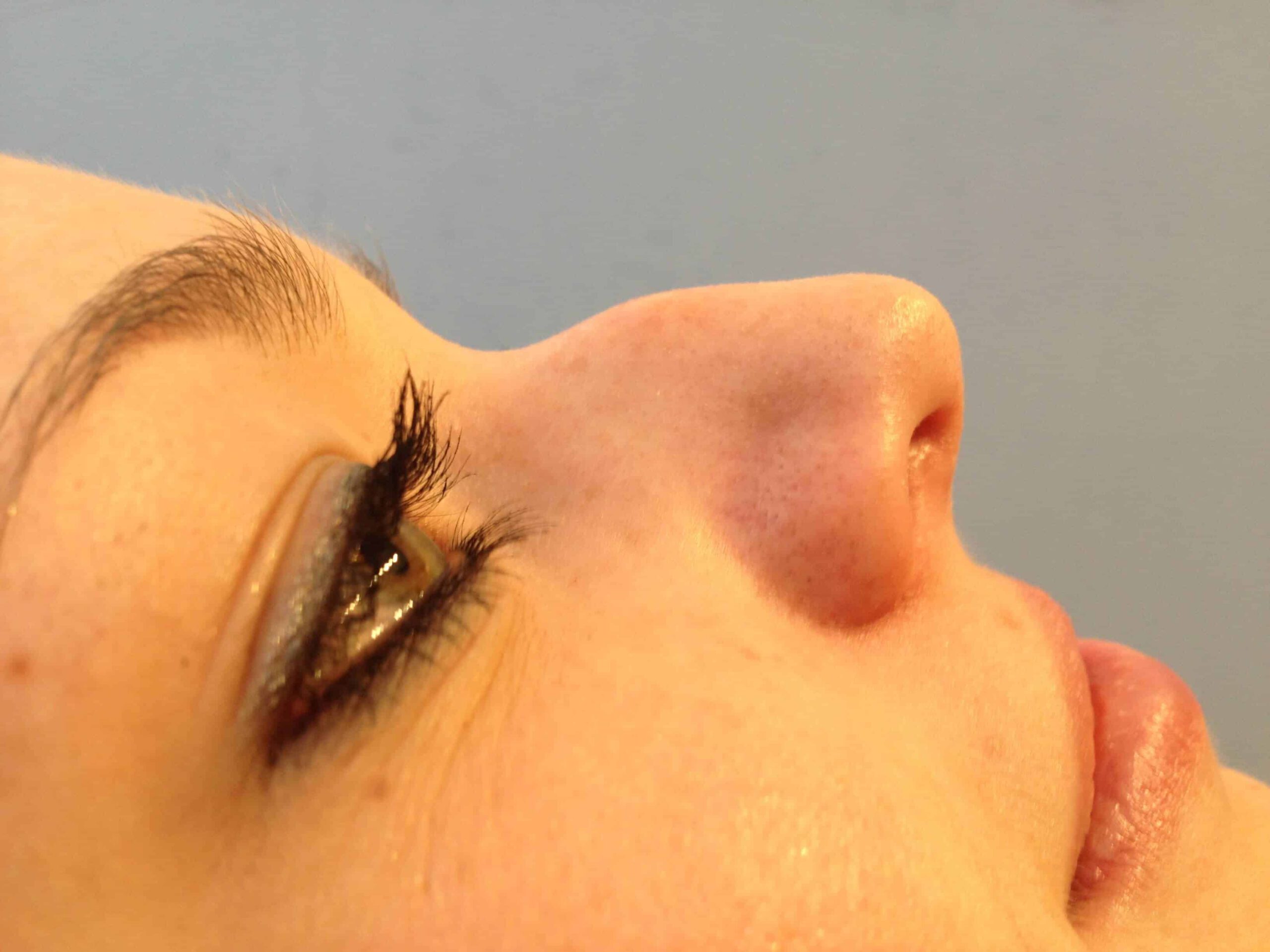 5 Minute Nose Job - Before and After Gallery – Photo 8